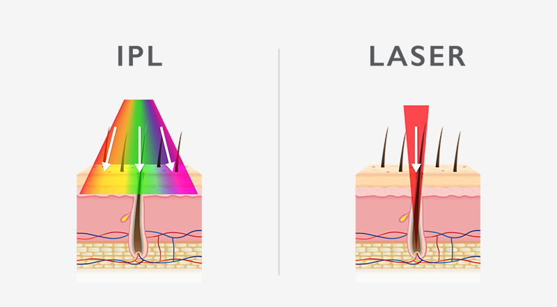 ipl-vs-laser-03